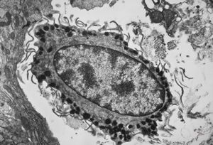 M,11y. | mast cell - skin